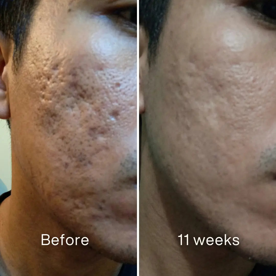 Acne Scar Invisible Repair BBOJI™