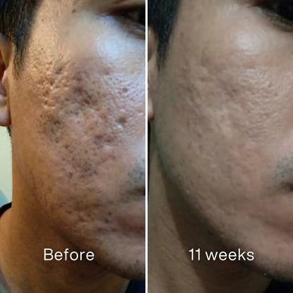 Acne Scar Invisible Repair BBOJI™