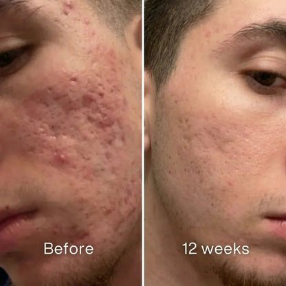 Acne Scar Invisible Repair BBOJI™